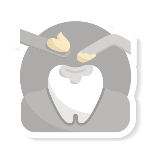 tooth filling done after removal of decay from the tooth