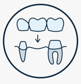 to replace missing tooth/teeth , a bridge can be placed.