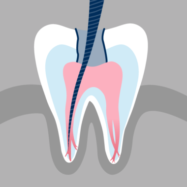 for removing infected tissues from the tooth root pulp and then filling it with a root canal filling material to avoid further infection.