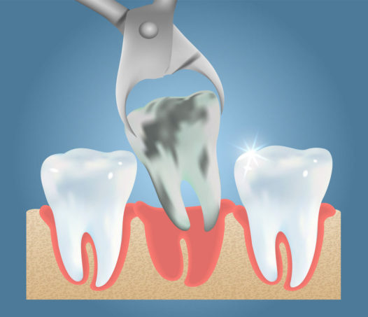 removal of tooth