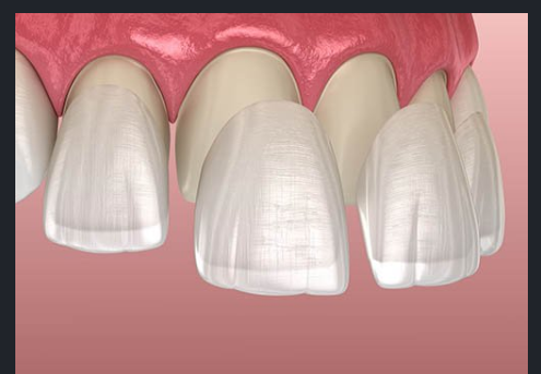 with minimal shaping of teeth