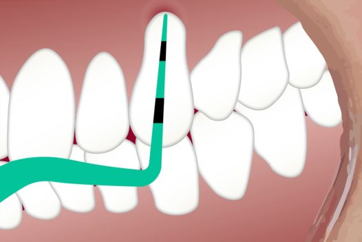 gum surgeries for gingival recession