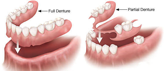 removable prosthesis for complete or partial loss of teeth.